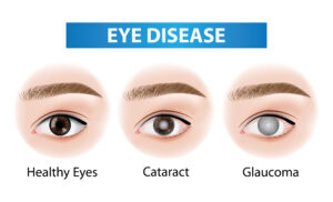 what are cataracts